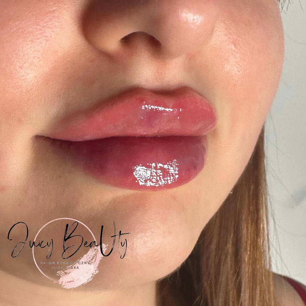 Powiększanie ust modelowanie ust